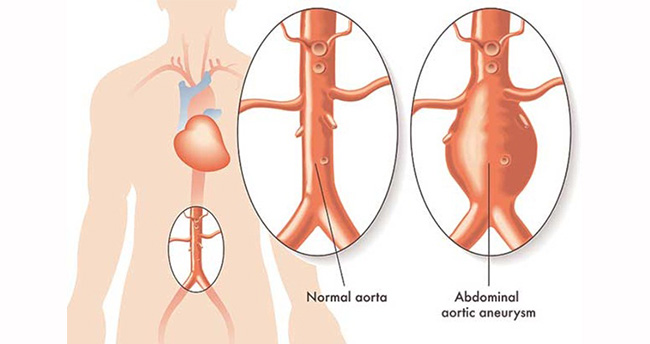 aort-damari-yirtilir-2