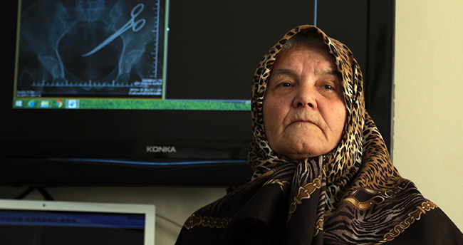 Karnında unutulan makasla 5 yıl yaşadı