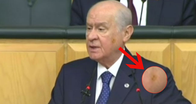 Devlet Bahçeli’nin yüzüne ne oldu?