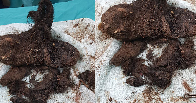 Midesinden çıkanlar doktorları bile şaşırttı! Tam 700 gram