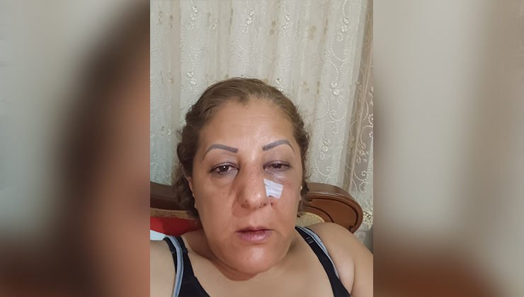 Apartman bahçesinde beslediği kediler nedeniyle komşuları tarafından darbedilen kadının burnu kırıldı