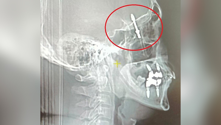 Beynine saplanan implant hayatını kararttı: 2 yıldır adalet bekliyor