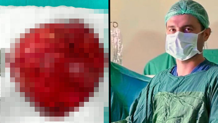 Konya’da bir hastanın karın boşluğundan 40 santimetre büyüklüğünde kitle çıkarıldı