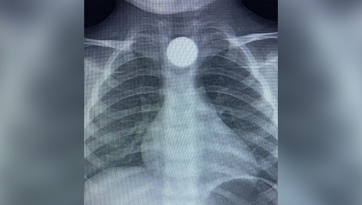 3 yaşındaki Bilal’in, yuttuğu 50 kuruş yemek borusunda takıldı