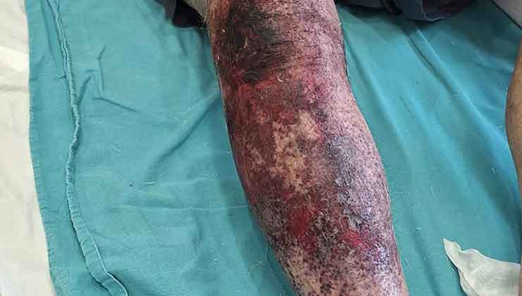 Tıkalı lavaboyu açmaya çalıştı, kimyasal yanıkla hastanelik oldu