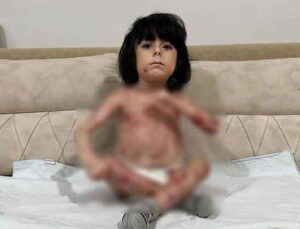 Yaraları tüm vücudunu sardı! ‘Kelebek hastalığı’ nedeniyle kıyafet giyemiyor